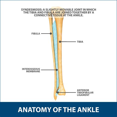 High Ankle Sprain Florida Orthopaedic Institute
