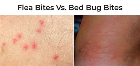 Bed Bug Bites Vs Flea Bites