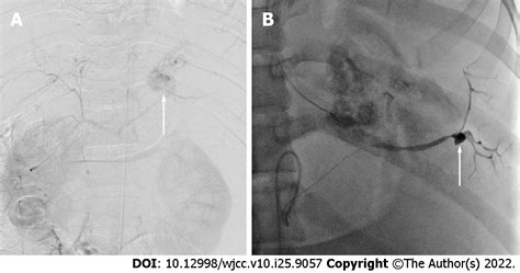 Ruptured Splenic Artery Aneurysms In Pregnancy And Usefulness Of