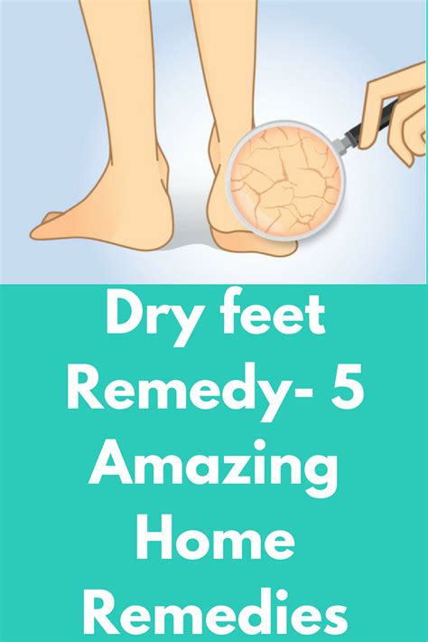 Dry Feet Remedy 5 Amazing Home Remedies So You Went To Try On A Pair Of Shoes And Realized That