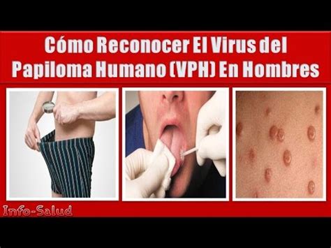 Virus Del Papiloma Humano Como Reconocer El Virus En Los Hombres YouTube