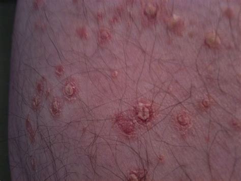 I Have A Very Itchy Rash On My Back In Clusters Along With