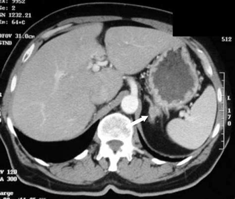 A Ct Scan Of Left Adrenal Gland Showing A 1 Cm Hypodense Mass Within