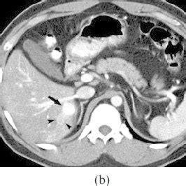 A liver shunt means that your new puppy isn't using his liver at all. (PDF) Colour Doppler sonography of hepatic haemangiomas ...