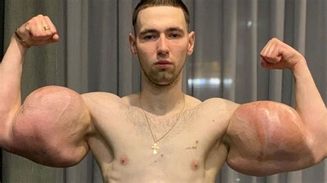 Russian Popeye Has 3 Pounds Of Dead Muscle Removed After Diy Bodybuilding Injections