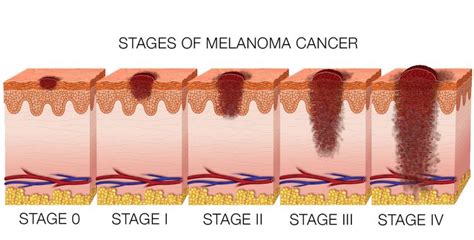 Skin Cancer Melanoma The Four Stages