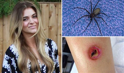 Monster Spider Bites Leaves Woman Suffering Months Of Agony Uk News