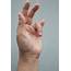 Trigger Finger Causes And Treatments  Health Themountaineercom