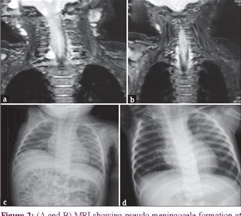 Figure 2 From Neonatal Brachial Plexus Injury With Diaphragmatic