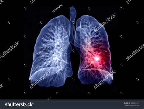 Selective Focus Ct Chest Lung 3d Stock Illustration 1683329149