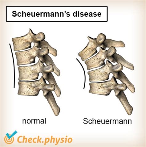 Scheuermanns Disease Physio Check
