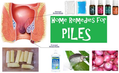 best home remedies for piles home remedies for hemorrhoids home remedies hemorrhoid remedies