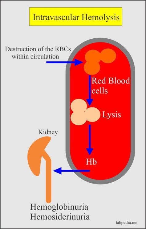 Anemia Part 8 Hemolytic Anemias Classification Autoimmune