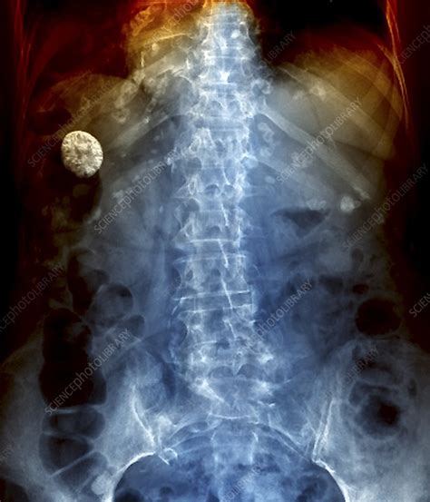 Gallstone X Ray Stock Image M1650352 Science Photo Library