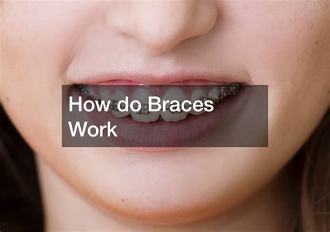 How Do Braces Work Dental Magazine