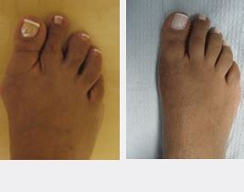 Astoria Foot and Ankle Surgery Foot Care Photo Gallery