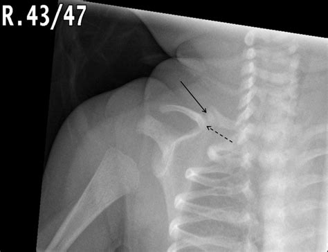 A Rare Clavicular Lump In A Baby Congenital Pseudarthrosis Archives