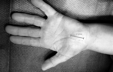 A2b Minimal Incision Open Carpal Tunnel Decompression Download