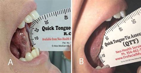 The Importance Of Orofacial Myofunctional Therapy Before And After Co2 Laser Frenectomy In