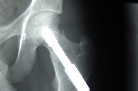 Infection Risk Spikes After Hip Surgery Study Says