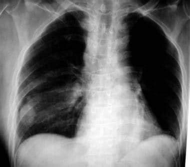 What Causes Pulmonary Nodules