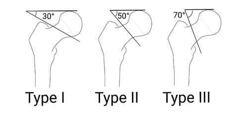 Fractured Neck Of Femur Fnof Orthopaedics Geeky Medics