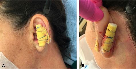 Treatment Of Pseudocyst Of Auricle Journal Of The American Academy Of