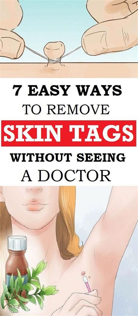 7 easy and homemade ways to remove skin tags without going to a doctor wellness magazine