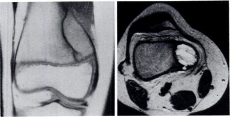 Aneurysmal Bone Cyst Of Distal Femur In A 9 Year Old Child Complaining