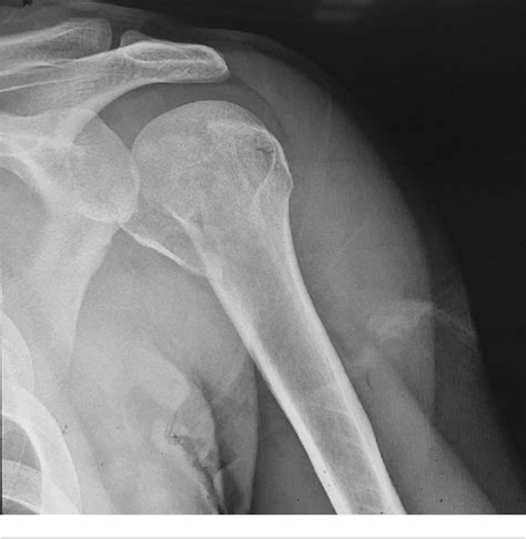 Figure 1 From Locked Posterior Dislocation Of Shoulder With Fracture Of