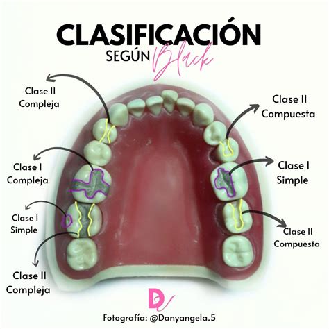 ⭐cavidades Segun Black Odontología Escuela De Higiene Dental