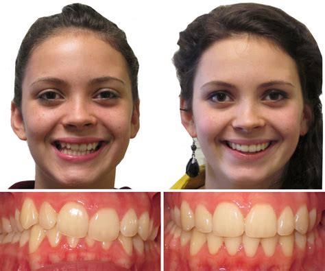 Зубы До И После Брекетов Фото Telegraph