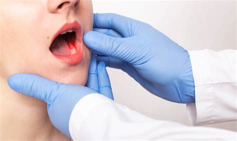 oral cancer screening what to expect and why it matters