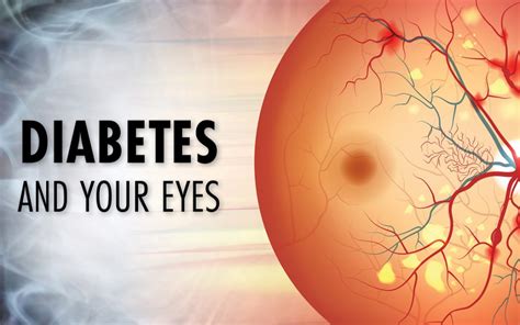 Diabetic Eye Disease Eye Health Complications Of Diabetes