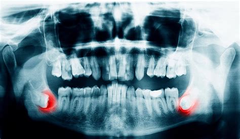 Does A Dental X Ray And Radiation Hurt Patients