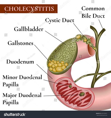 Cholecystitis Inflammation Of The Gallbladder And Bile Ducts