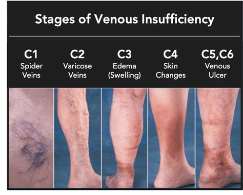 Venous Stasis Ulcer Stages