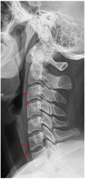 The Natural Course Of Prevertebral Soft Tissue Swelling After Anterior