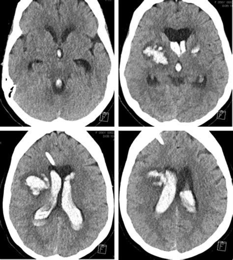 Basal ganglia stroke arteries carry blood that contains oxygen to the brain. Basal ganglia hemorrhage in a case report following spinal ...
