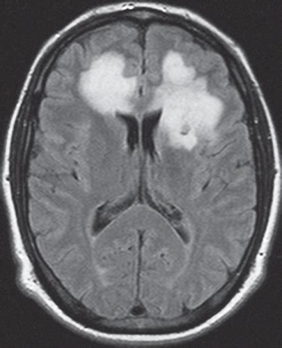 White Matter Diseases With Radiologic Pathologic Correlation