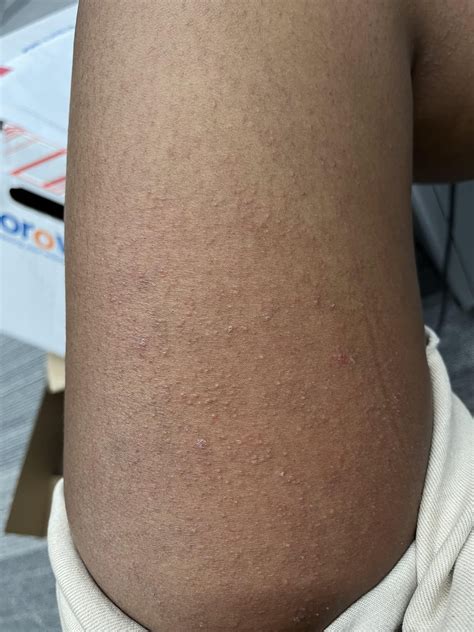 Little Itchy Red Bumps All Over Body Rskin