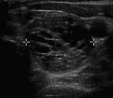 Pattern Recognition Of Benign Nodules At Ultrasound Of The Thyroid Which Nodules Can Be Left