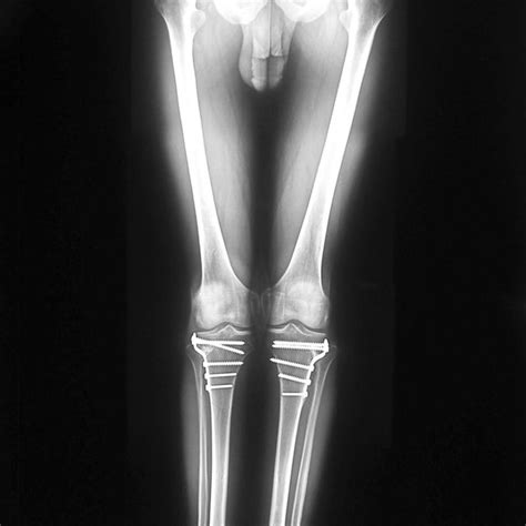 A 42 Year Old Man With Prior Closing Wedge High Tibial Osteotomy And
