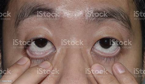 Pale Skin Of Asian Man Sign Of Anemia Pallor At Eyelid Stock Photo