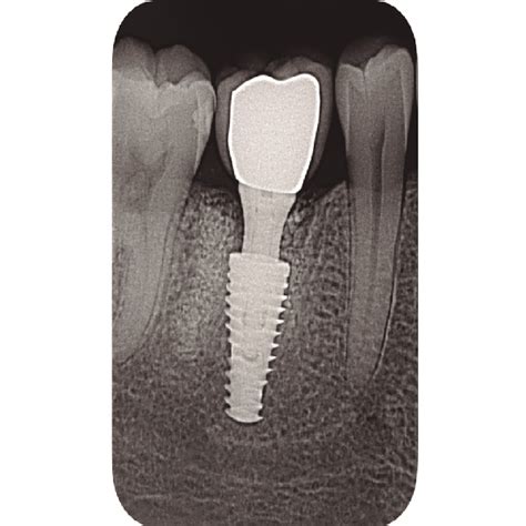 Periapical Radiograph 2 Years After Implant Placement Download