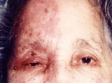 Zoster rash on the forehead or eyelid plus eye findings. About Herpes Page 207