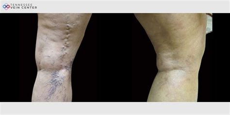 Varicose Veins Before And After Vein Treatment Center Alcoa Tn