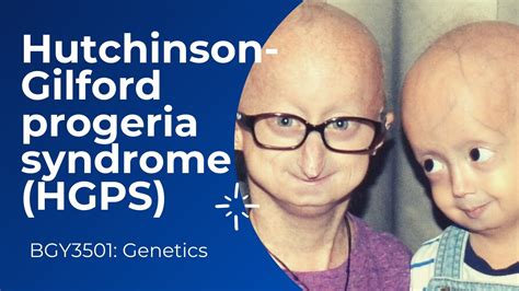 Bgy3501 Genetics Hutchinson Gilford Progeria Syndrome Group 5 Youtube