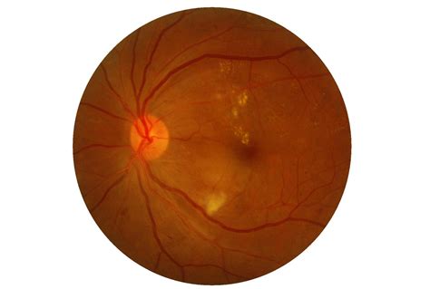 Retinal showing Exudates