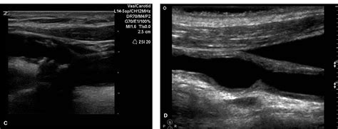 Cerebrovascular Sonography Lange Review Ultrasonography Examination